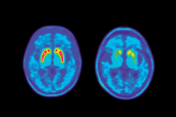 Servis mozgu pri Parkinsonovej chorobe